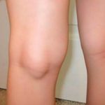 Киста Бейкера коленного сустава: причины возникновения, симптомы и лечение (с фото)