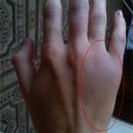 Ушиб кисти руки при ударе и падении: симптомы и лечение