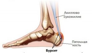 Симптомы бурсита пятки. Бурсит пятки (пяточный): лечение, симптомы и причины болезни Бурсит пятки: симптомы, лечение народными средствами и медикаментами. Бурсит пятки: лечение, симптомы, причины, фото - ГБУЗ МО "Озерская ЦРБ.
