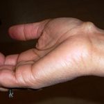 Гигрома на кисти руки: причины, чем она опасна, лечение