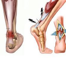 Растяжение сухожилий на ноге: симптомы, чем это опасно и что делать