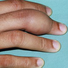 Что делать если опух палец на руке и чем это опасно