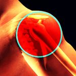 Остеохондроз плечевого сустава: симптомы, диагностика и лечение