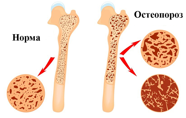 Норма и остеопороз