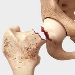 Перелом тазобедренной кости: симптомы, лечение и последствия
