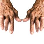 Артрит пальцев рук: симптомы и лечение (с фото)