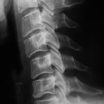Рентген шейного отдела позвоночника — как проводится что показывает
