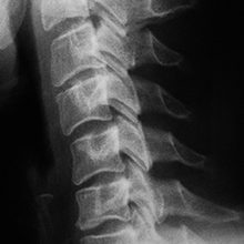 Рентген шейного отдела позвоночника — как проводится что показывает