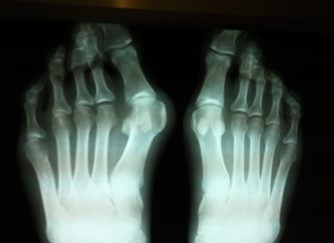Рентген пальцев ног