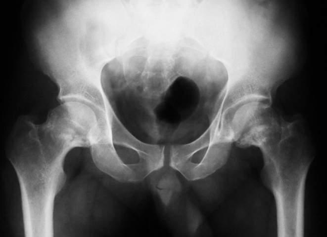 Рентген тазобедренных суставов