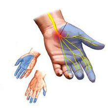 Немеют пальцы рук — возможные причины и болезни