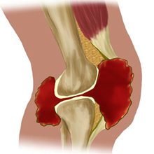 Жидкость в коленном суставе — причины появления, симптомы и лечение