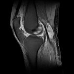 МРТ коленного сустава: что показывает и как проходит (с фото)