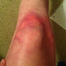 Ушиб колена (коленного сустава): симптомы и лечение