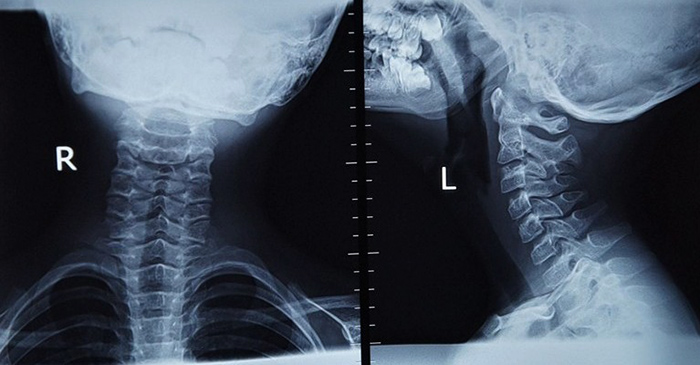 Вид шейного рентгена