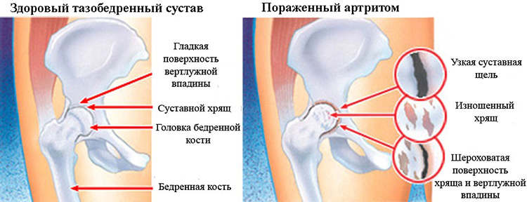 Здоровый и пораженный артритом сустав