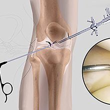 Артроскопия коленного сустава: что это, подготовка и проведение