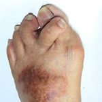 Артрит пальцев ног: причины, симптомы и лечение (с фото)