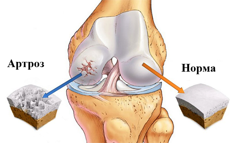 Норма и артроз