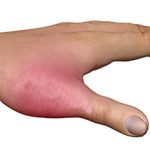 Перелом большого пальца руки: симптомы, диагностика и лечение