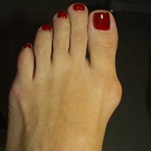 Вальгусная деформация большого пальца стопы: причины симптомы и лечение