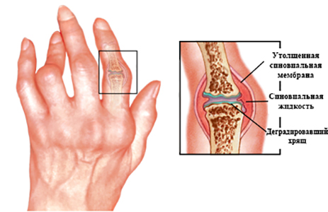 Ювенильный ревматоидный артрит