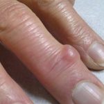 Гигрома пальца руки — симптомы и лечение (с фото)