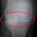 Хондропатия коленного сустава — что это, симптомы и методы лечения