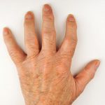 Артроз кисти руки: причины, симптомы и лечение (с фото)