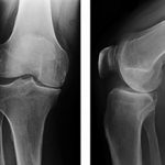 Рентген коленного сустава: что показывает и как проводится