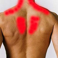 Миозит (воспаление) мышц спины: причины, симптомы и лечение