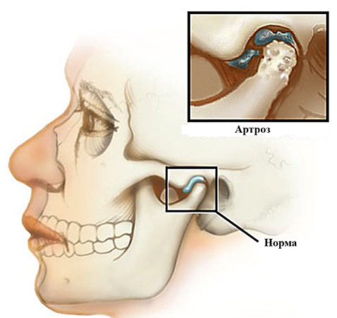 Артроз челюстно-лицевого сустава