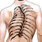 Сколиоз грудного отдела позвоночника: симптомы и методы лечения