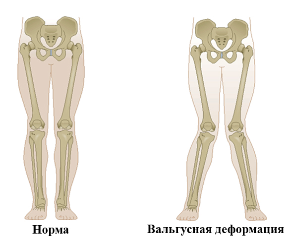 Деформированное колено