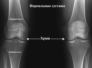 Подагра коленного сустава фото