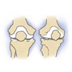 Деформирующий остеоартроз коленного сустава (доа): что это, степени и лечение