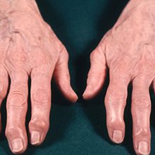 Остеоартроз кистей рук: причины, симптомы и лечение