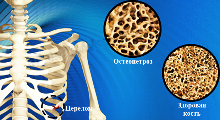 Остеопетроз и здоровая кость