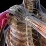 Неврит плечевого нерва: причины, симптомы и лечение