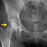 Рентген тазобедренных суставов: подготовка и проведение