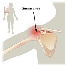 Импиджмент синдром плечевого сустава: причины, симптомы и лечение