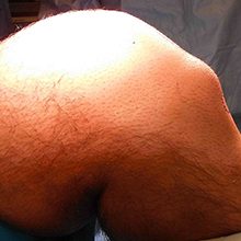 Болезнь Шляттера коленного сустава: причины, симптомы и лечение (с фото)