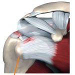 Разрыв сухожилия надостной мышцы плеча: симптомы и методы лечения