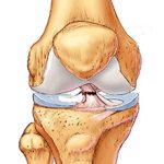 Разрыв крестообразной связки колена: что это, симптомы и лечение