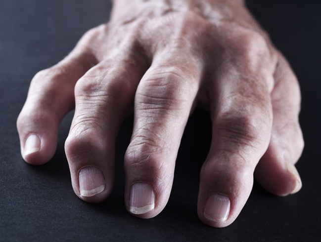 Руки при ревматоидном артрите