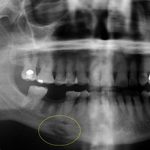 Остеомиелит челюсти (нижней и верхней): симптомы и лечение (с фото)