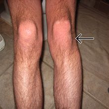 Вывих коленного сустава: симптомы, диагностика и лечение