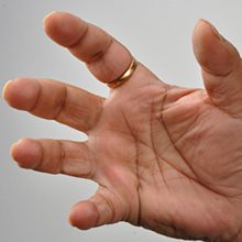Синдром щелкающего пальца: симптомы, диагностика и лечение