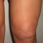 Синовит коленного сустава: виды, симптомы и лечение (с фото)