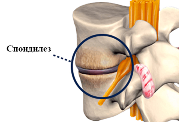 Спондилез